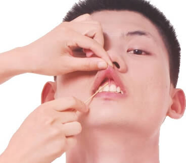 龈交穴的正确位置图