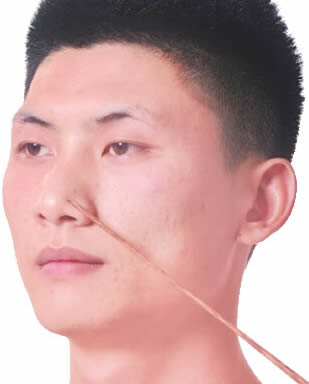 内迎香穴的正确位置图